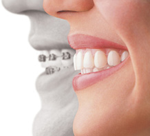 <em>Invisalign</em> Profiles