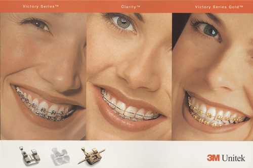 Traditional Braces